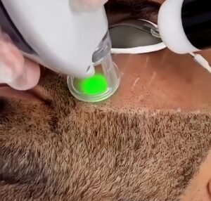 Men Beard Shaping laser hair removal