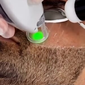 Men Beard Shaping laser hair removal