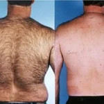 laser hair removal before and after back body