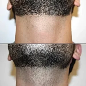 Laser hair removal before and after 1 session