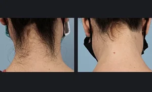 Laser hair removal results after 2 sessions