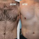 Permanent laser hair removal before and after