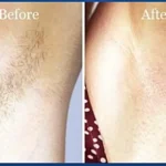 Laser hair removal Before and after men