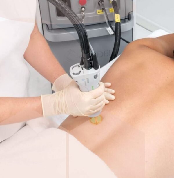 Mens Full & Shoulders Back Laser Hair Removal Laser Perfect Ilford Essex