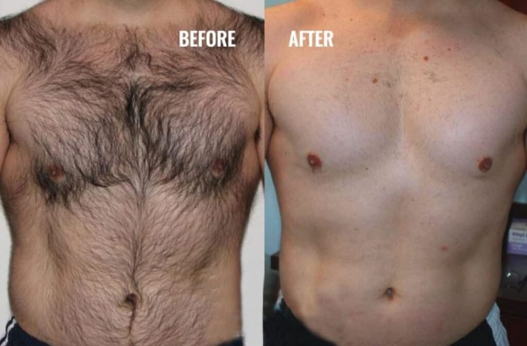 men's Laser Hair Removal Before and After Pictures