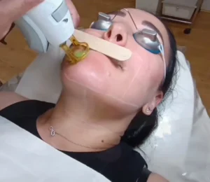 Woman receiving laser hair removal treatment on the face in a beauty laser perfect laser-clinic in Ilford London
