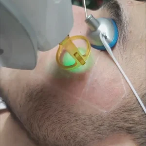 Man with precisely sculpted beard line after laser beard sculpting at Laser Perfect laser hair removal clinic in London
