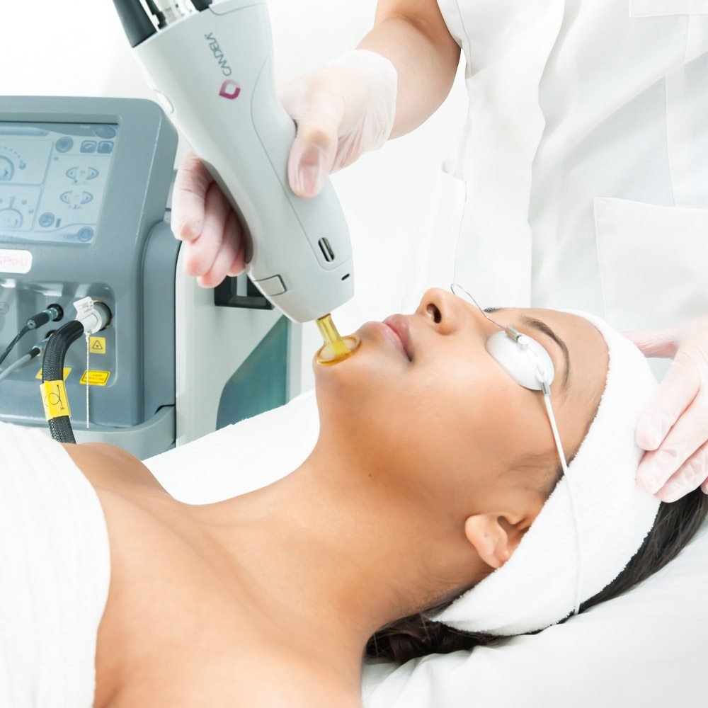 Woman receiving professional laser hair removal on face and neck at a clinic, showing smooth skin treatment with laser device