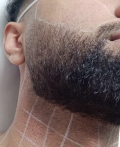 Man receiving professional laser hair removal on face and neck at a clinic