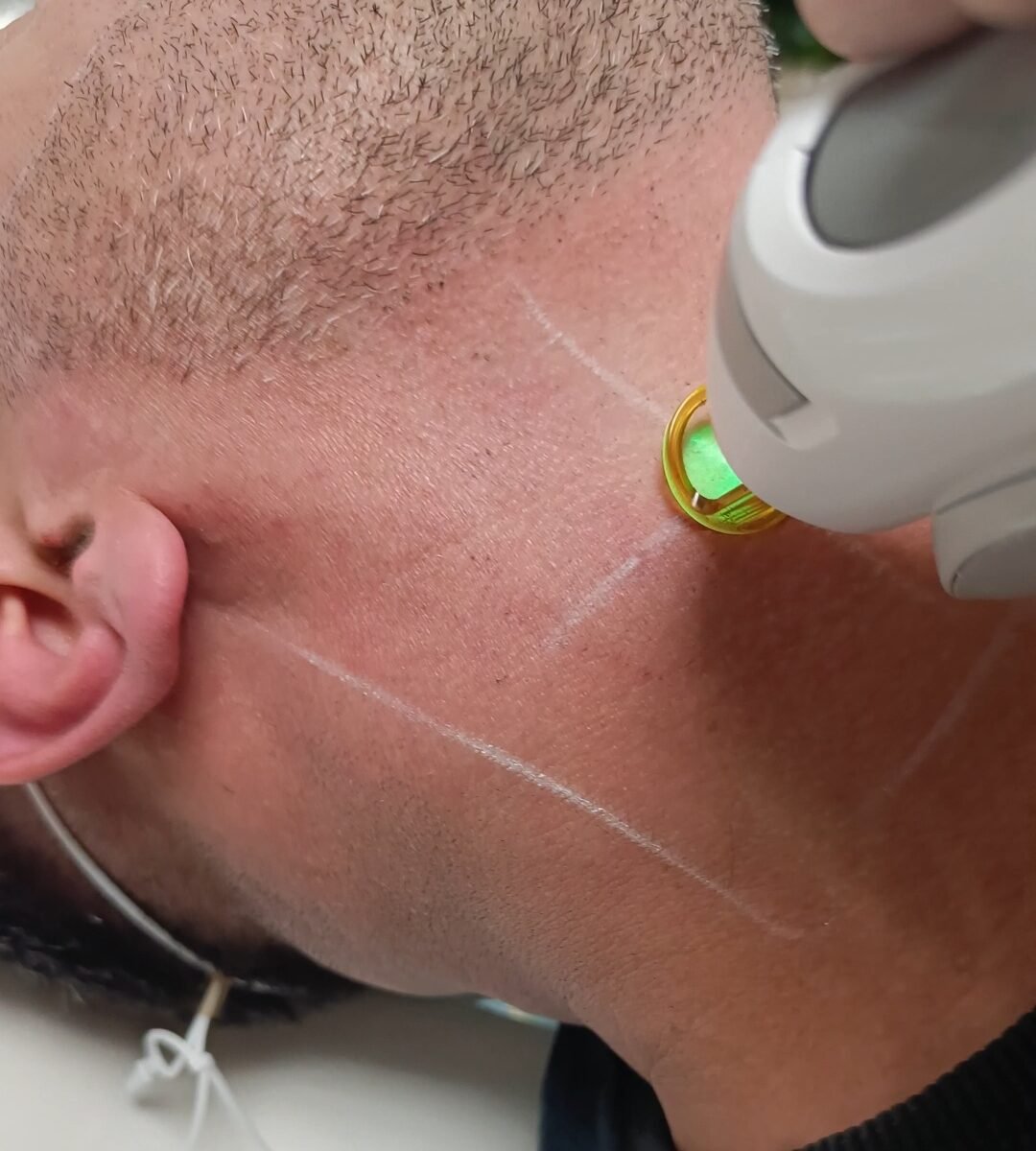 Full Beard Laser Hair Removal Treatment for Men in Gants Hill Ilford Redbridge