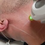 Full Beard Laser Hair Removal Treatment for Men in Gants Hill Ilford Redbridge