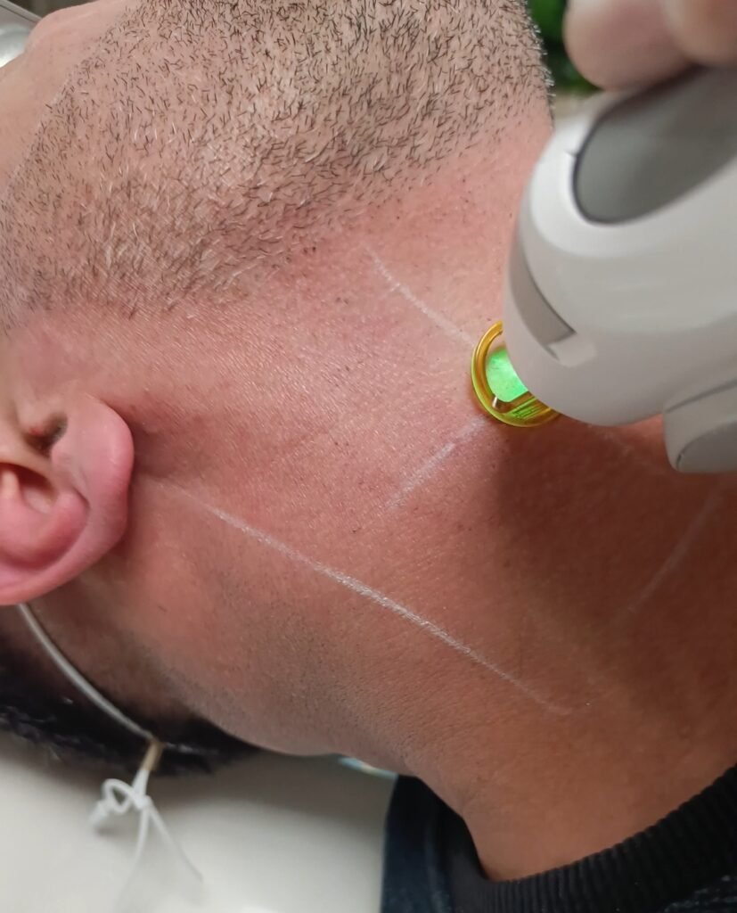Laser beard sculpting treatment in progress