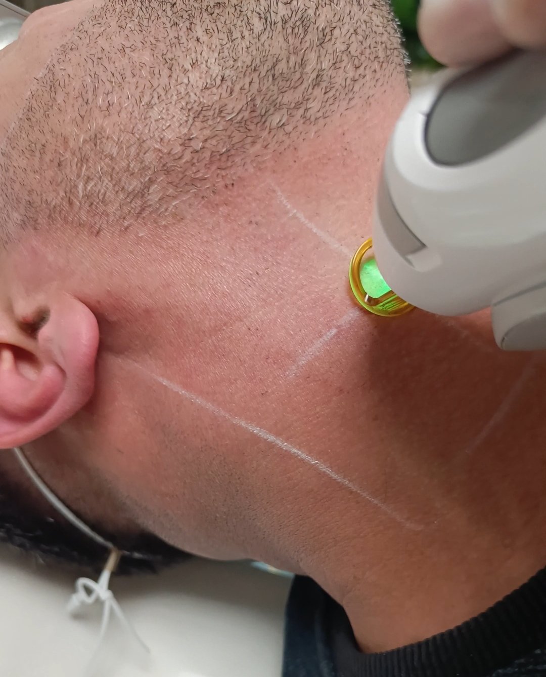 Full Beard Laser Hair Removal Treatment for Men in Gants Hill Ilford Redbridge