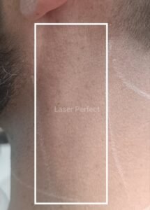 Male facial side neck laser hair removal treatment at Laser Perfect laser clinic in Ilford London using advanced laser technology for long-lasting hair reduction.
