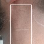 Male Facial - Side Neck Laser Hair Removal