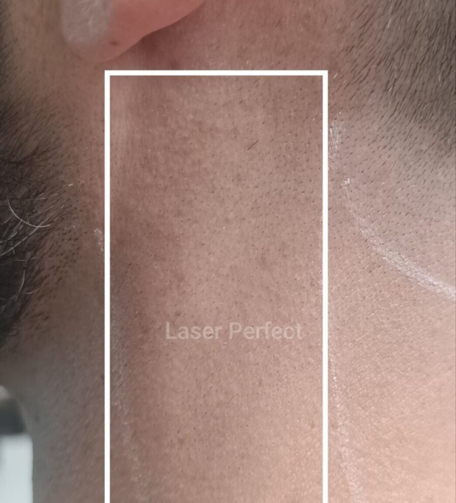 Side neck laser hair removal treatment at Laser Perfect in Ilford