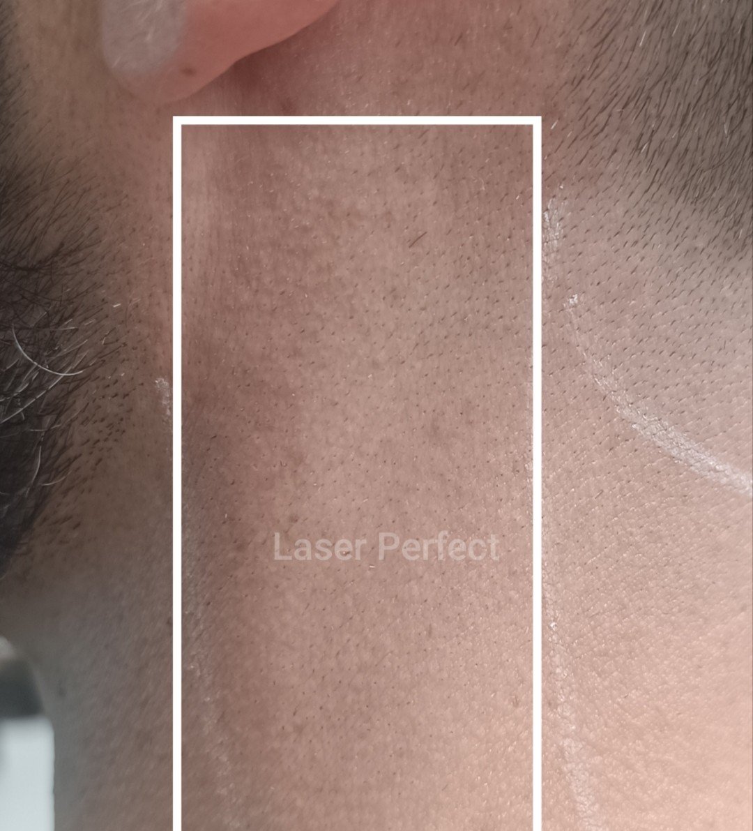 Male Facial Side Neck Laser Hair Removal Male Facial - Side Neck Laser Hair Removal - Image 1