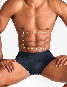 Professional Male Abdomen Laser Hair Removal treatment for long-lasting hair reduction and smoother, confident skin.