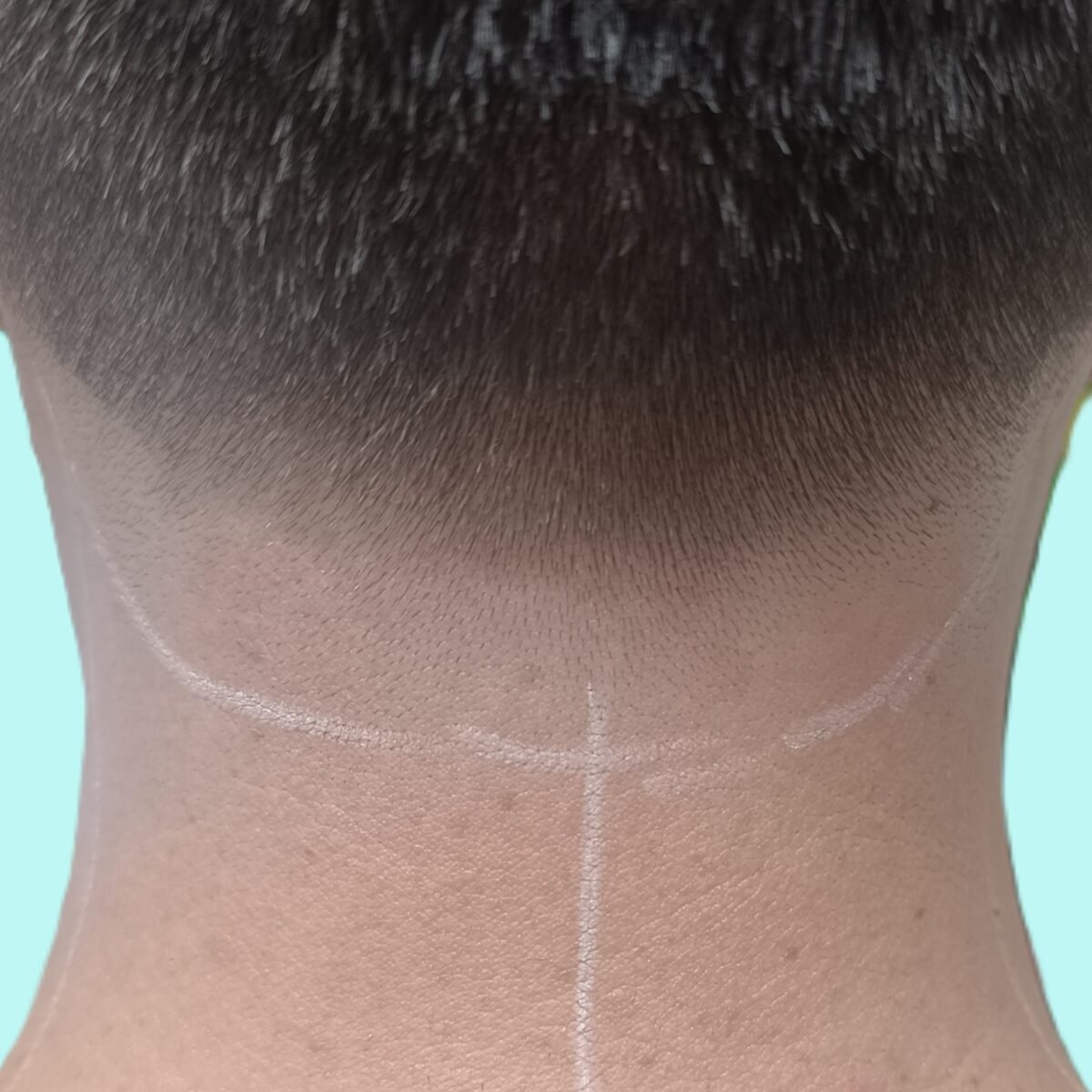 Men back neck laser hair removal treatment at Laser Perfect laser clinic in Ilford London