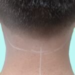 Men back neck laser hair removal treatment at Laser Perfect laser clinic in Ilford London