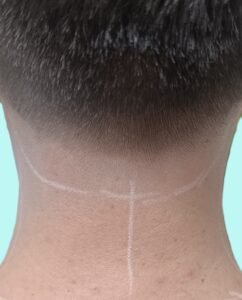 Men back neck laser hair removal treatment at Laser Perfect laser clinic in Ilford - Gantshill-Redbridge