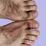Feet and toes laser hair removal