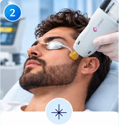 Laser beard sculpting treatment in Ilford with protective eye shields and laser handpiece above the beard line.