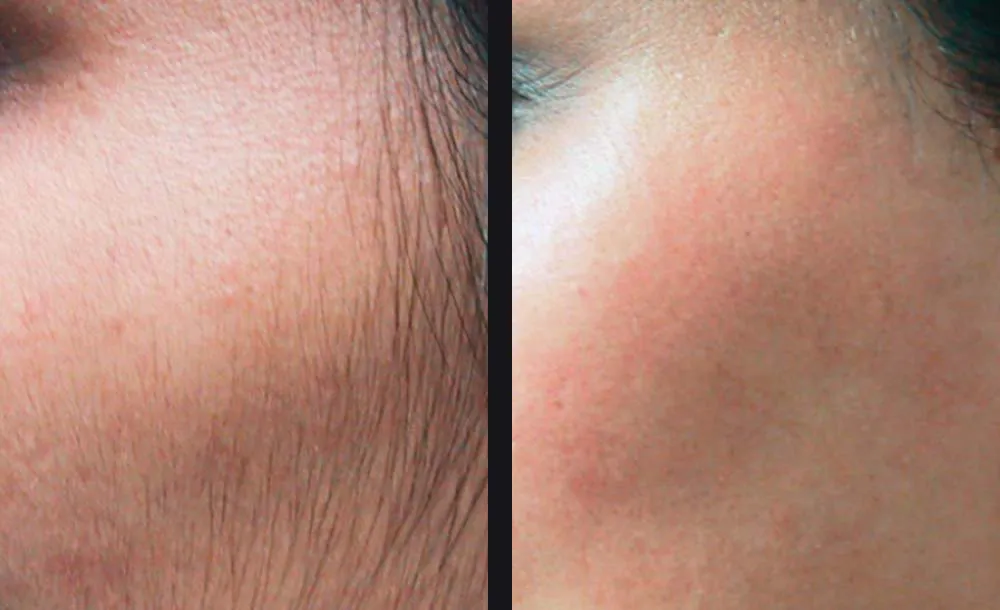 Before-and-after comparison showing changes in visible hair and skin appearance following Candela laser hair removal treatment.