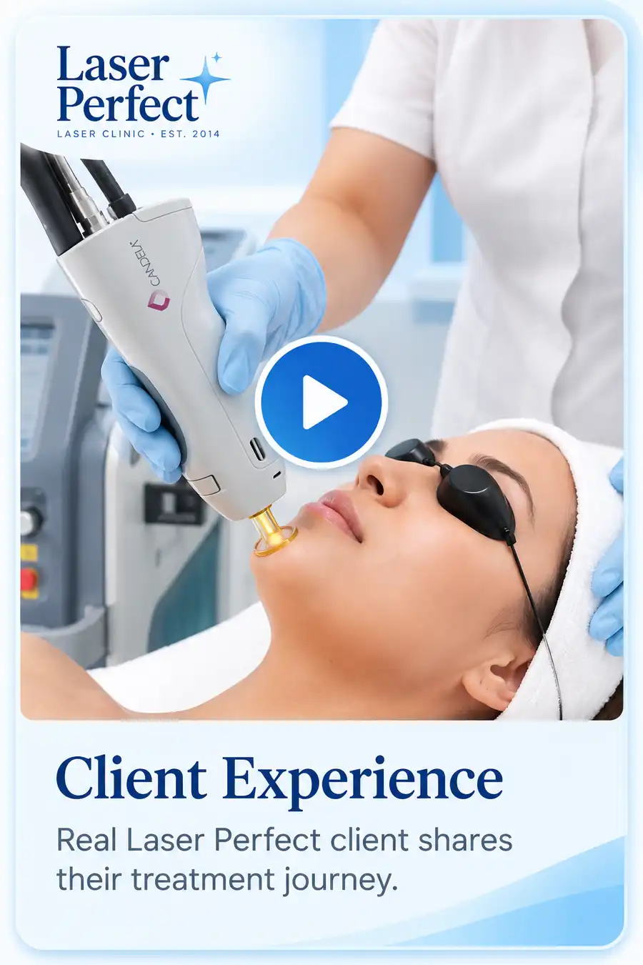 Female model receiving facial laser hair removal with a Candela handpiece and protective eye shields in a Laser Perfect promotional thumbnail.