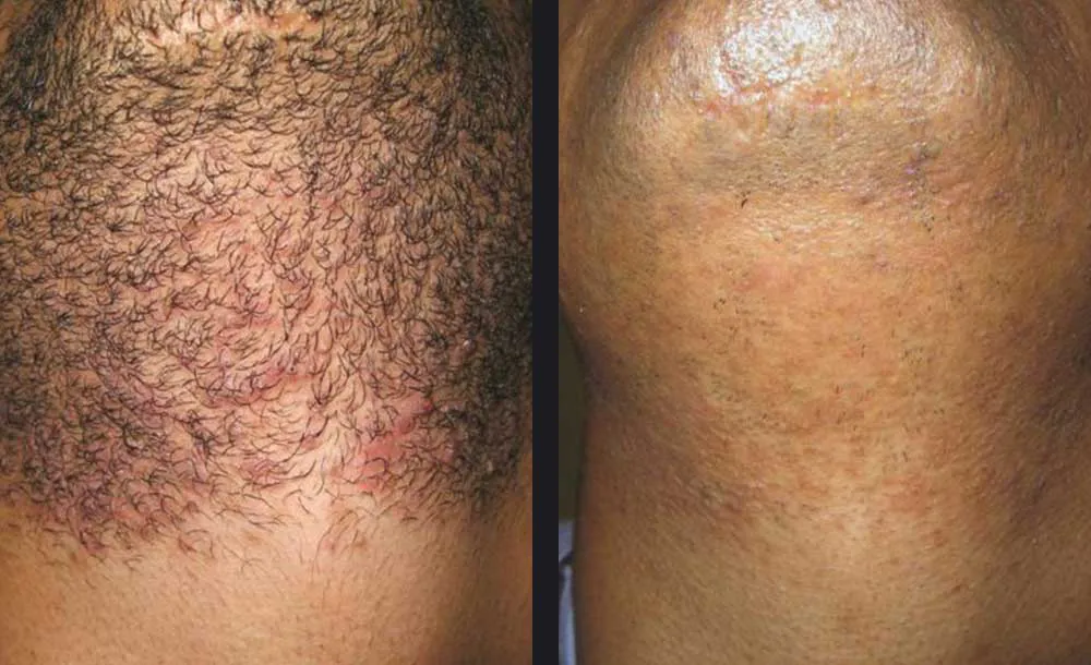 Before-and-after facial skin comparison illustrating changes in visible hair growth after Candela laser hair removal.