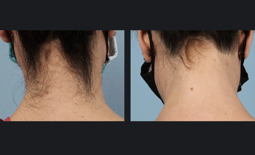 Before-and-after comparison of the back of the neck showing a cleaner hairline following Candela laser hair removal.