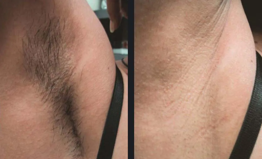 Before-and-after images showing visible underarm hair reduction following Candela laser hair removal treatment.