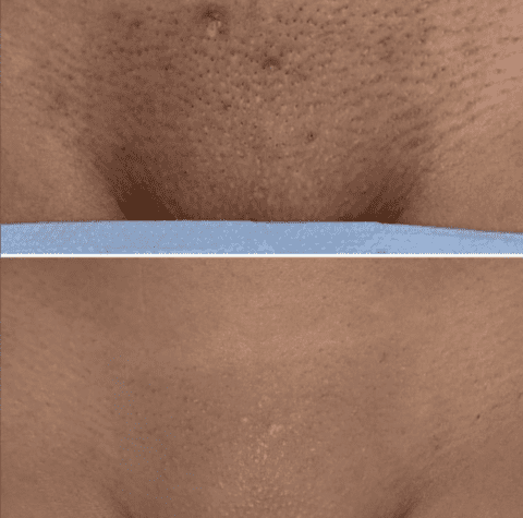 Before and After Laser Results – Best Hollywood Bikini Laser Hair Removal Clinic in Ilford London