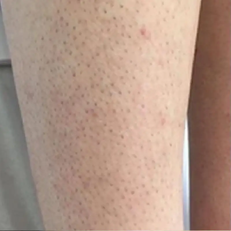 Legs requiring hair removal treatment