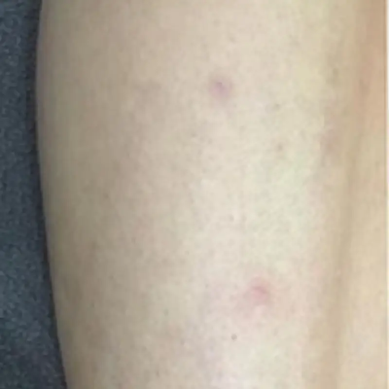 Legs smooth after Full Body Laser Hair Removal