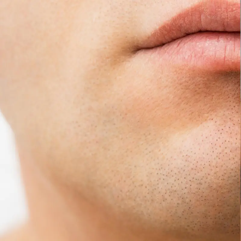 Male beard reduction Permanent Hair Reduction results