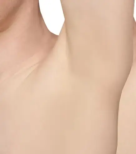 Underarms After Underarms Laser Hair Removal