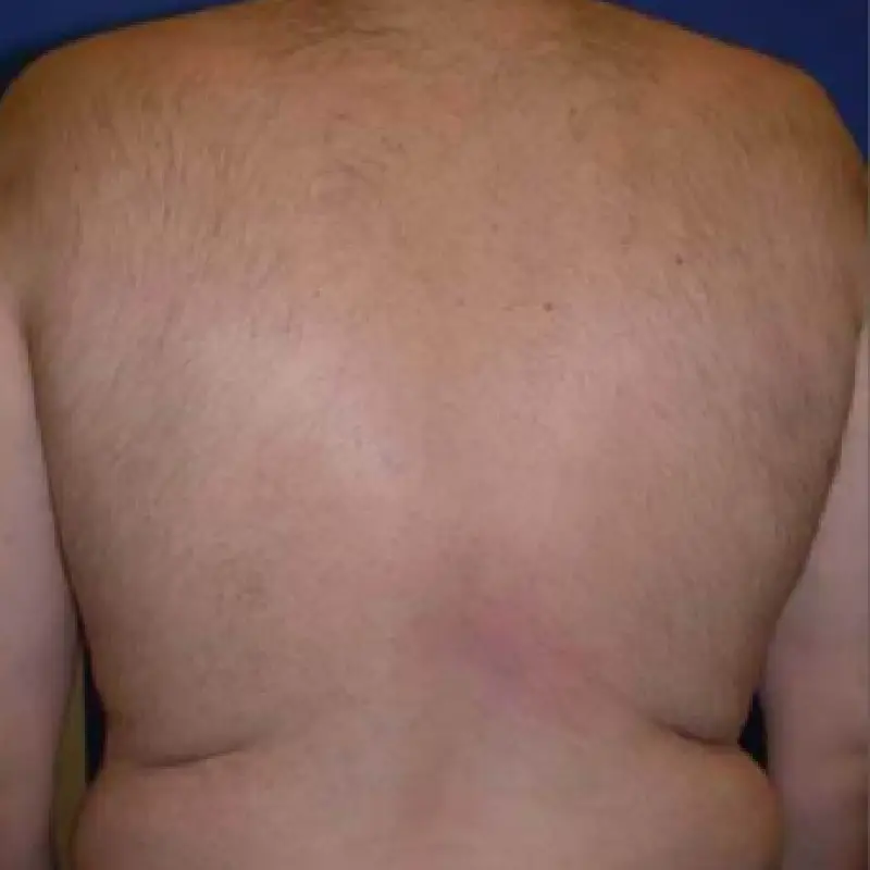 Back hair removed Pain-Free Laser Treatment results