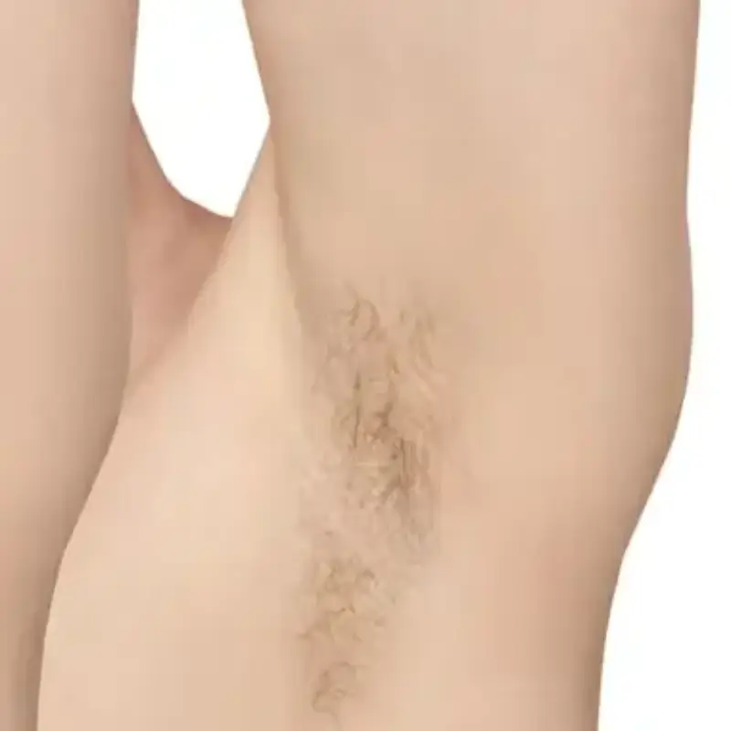 hairy Underarms before Laser Hair Removal