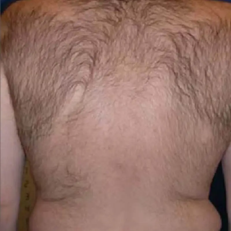 Back hair requiring Pain-Free Laser Treatment results