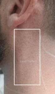 Male facial side neck laser hair removal treatment  at Laser Perfect - laser clinic, Ilford - Redbridge